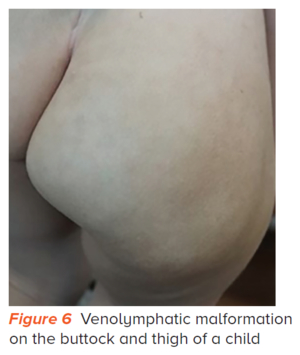 Venolymphatic malformation - SingHealth Duke-NUS Vascular Centre