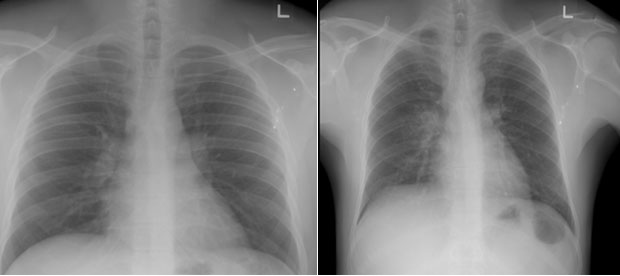  ​(L) Normal Chest X-Ray  (R) Abnormal Chest X-Ray