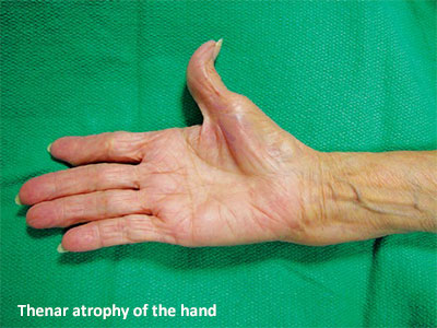 Thenar atrophy of the hand - SGH.