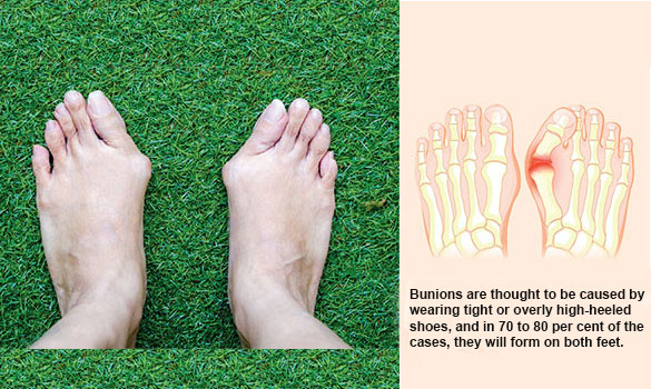 bunion healing sandals