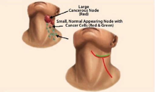 head & neck surgery