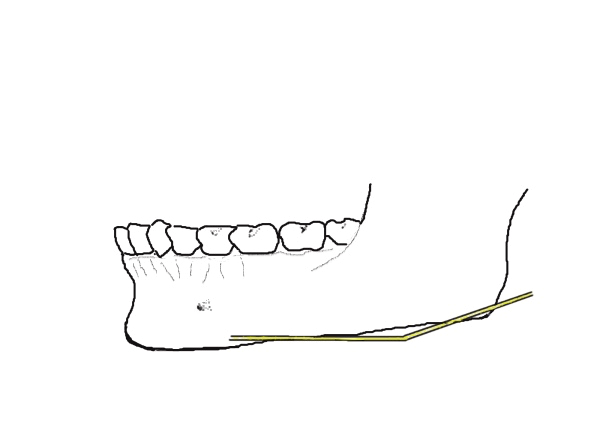 course of the marginal mandibular nerve