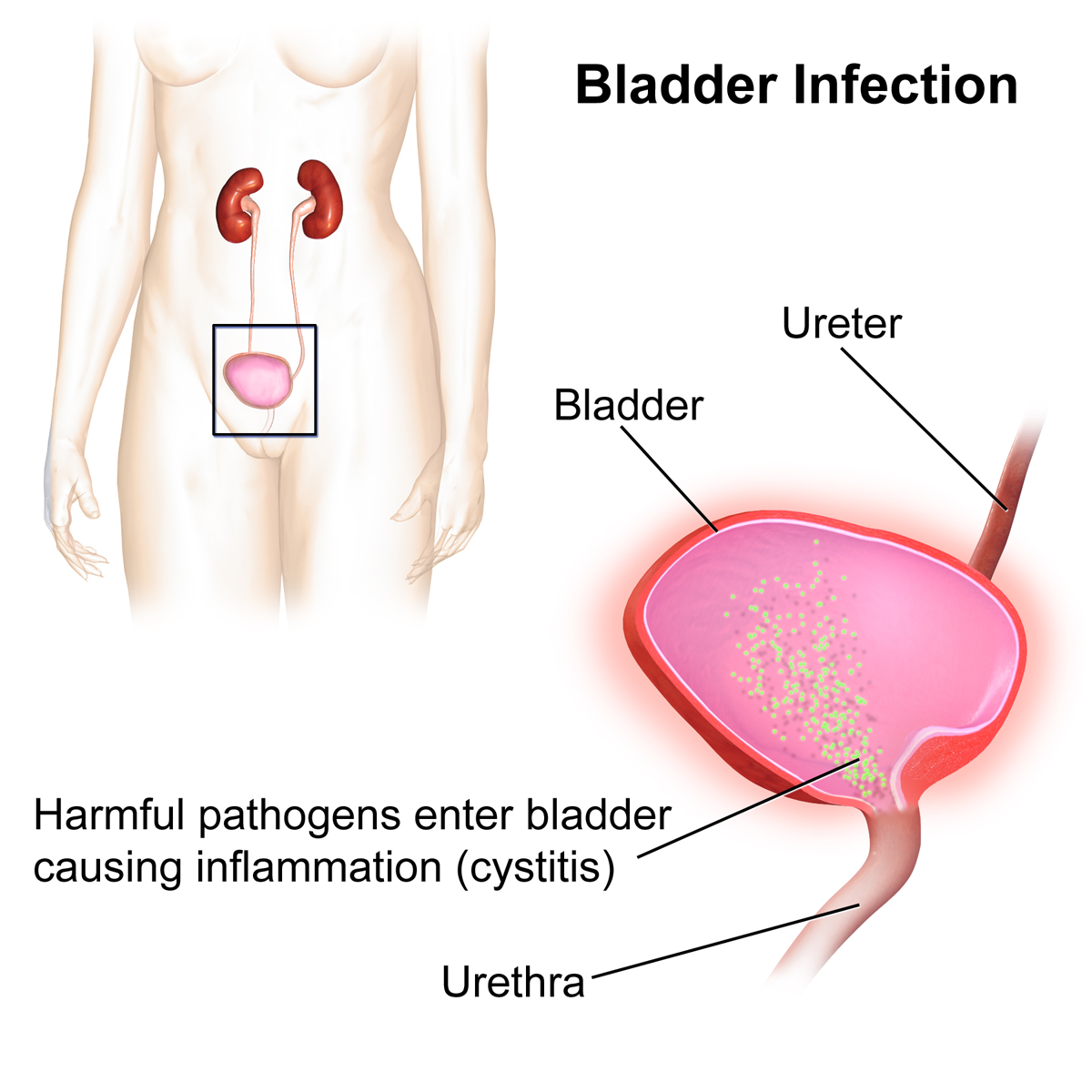 Urinary Tract Infection (UTI) - SGH