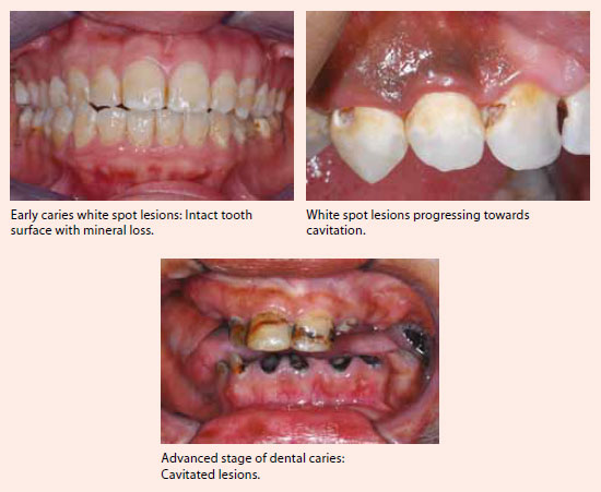 Adult caries treatment at National Dental Centre Singapore