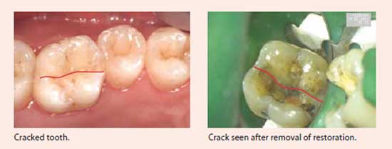 Cracks in the tooth structure - National Dental Centre Singapore