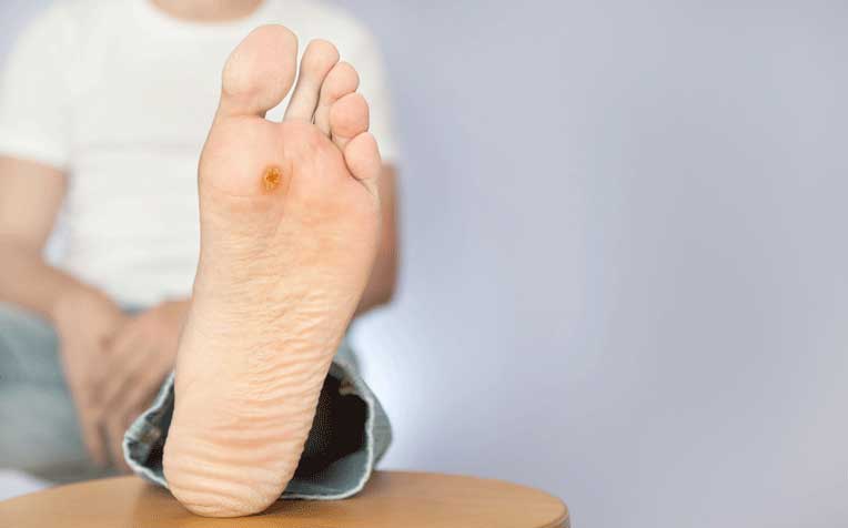 PLANTAR WARTS  are caused by a specific type of HPV that can be trasmitted from contaminated objects and surfaces.