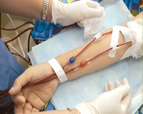 Dialysis Procedure Treatment