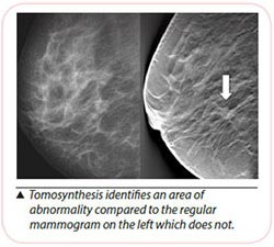 breast cancer diagnosis tomosynthesis