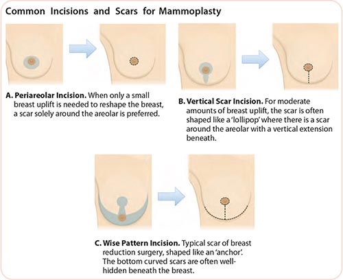 breast-conserving surgery with mammoplasty
