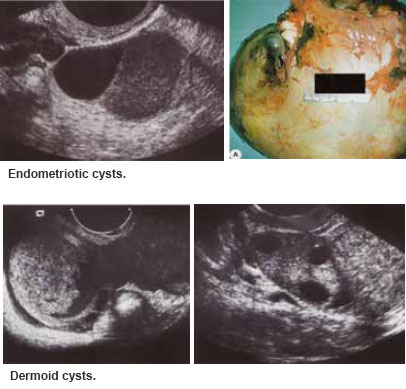 Endometriotic and dermoid cysts are benign ovarian cysts - Ovarian Cyst condition and treatments.