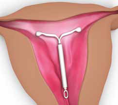 Levonorgestrel intrauterine system (LNG-IUD) - Mirena