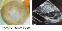 Corpus luteum cysts is one type of ovarian cysts - Ovarian Cyst condition and treatments.