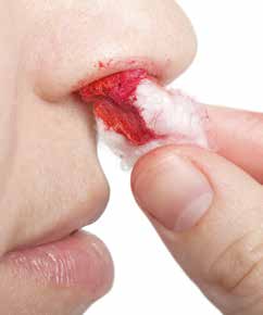 Epistaxis causes include little's area epistaxis, trauma and cancer, according to SingHealth Duke-NUS Head and Neck Centre.