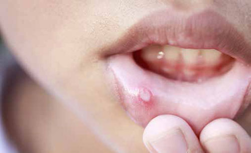 Mouth ulcers that have rolled or heaped-up edges should be viewed with a high-index of suspicion and reviewed at the SingHealth Duke-NUS Head and Neck Centre. Mouth ulcers condition and treatments SingHealth