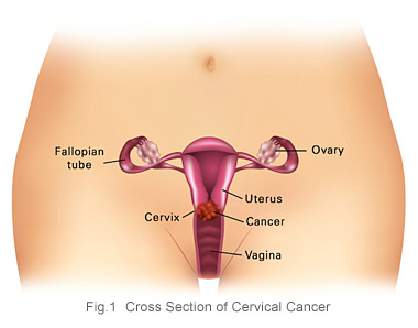Cervical cancer - cross section - KKH