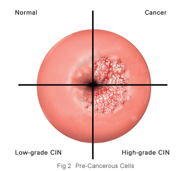 Cervical cancer - pre cancerous cells - KKH