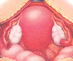 endometriosis and ovarian cysts