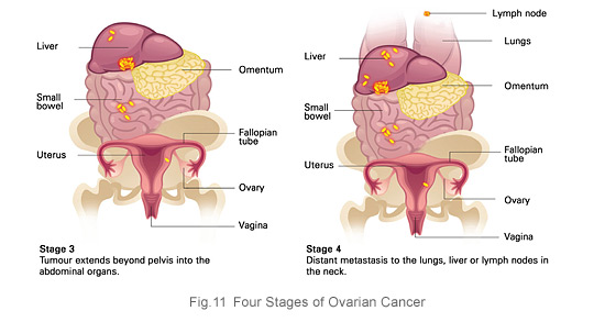 Ovarian cancer debulking surgery complications, Ovarian cancer debulking