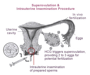 Superovulation and Intrauterine Insemination procedure at KKH