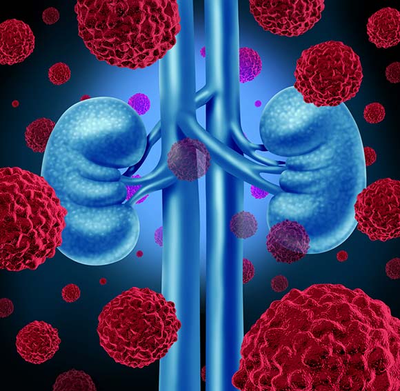 kidney cancer conditions and treatments