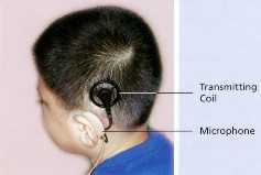 cochlear implant transmitter