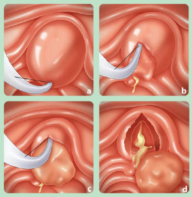Endoscopic removal Singapore General Hospital