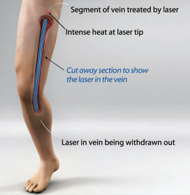 Endovascular Laser Therapy Singapore General Hospital