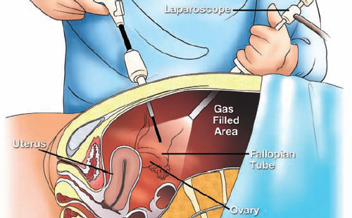 Laparoscopy in Obstetrics and Gynaecology Singapore General Hospital