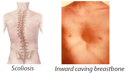 skeleton marfan's syndrome Scoliosis Inward caving breastbone
